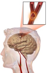 Accidentul vascular cerebral ischemic