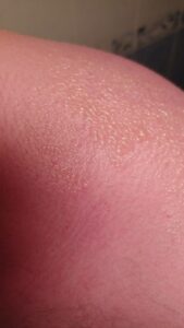 Ce sunt arsurile solare?